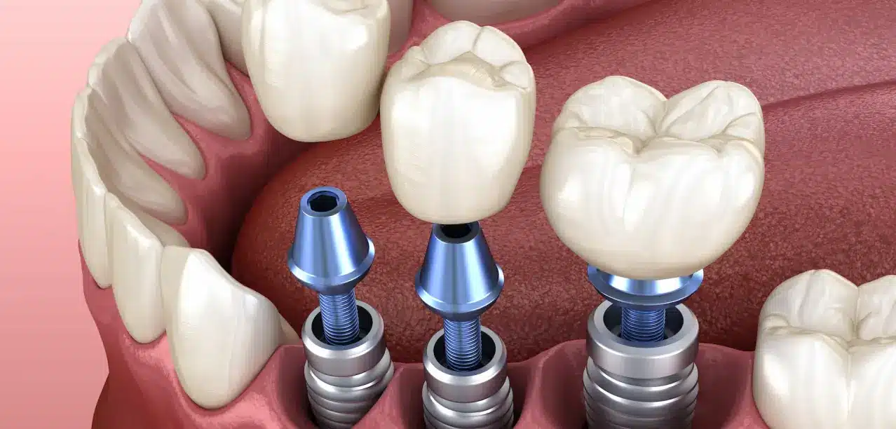 Clinica dental en madrid norte las tablas quintero dental