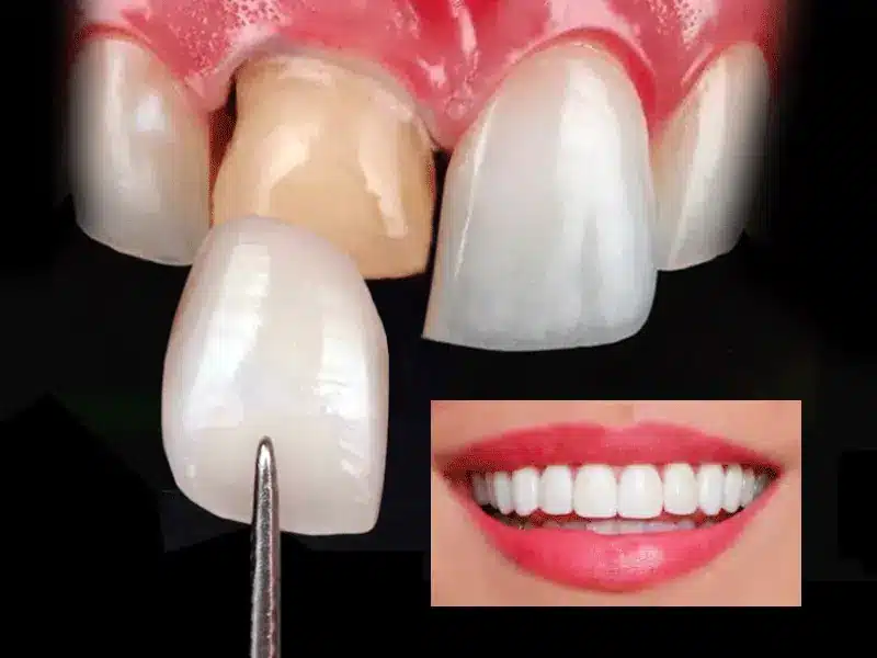 como se ponen las carillas dentales
