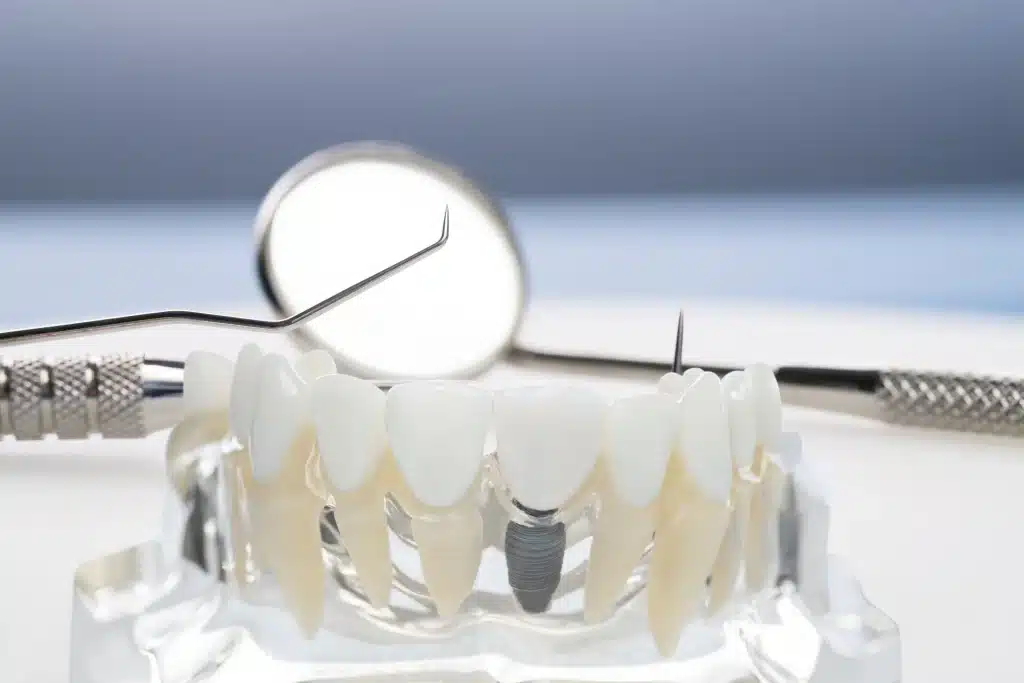 El Proceso De Implantes Dentales En Madrid las tablas Beneficios quintero dental