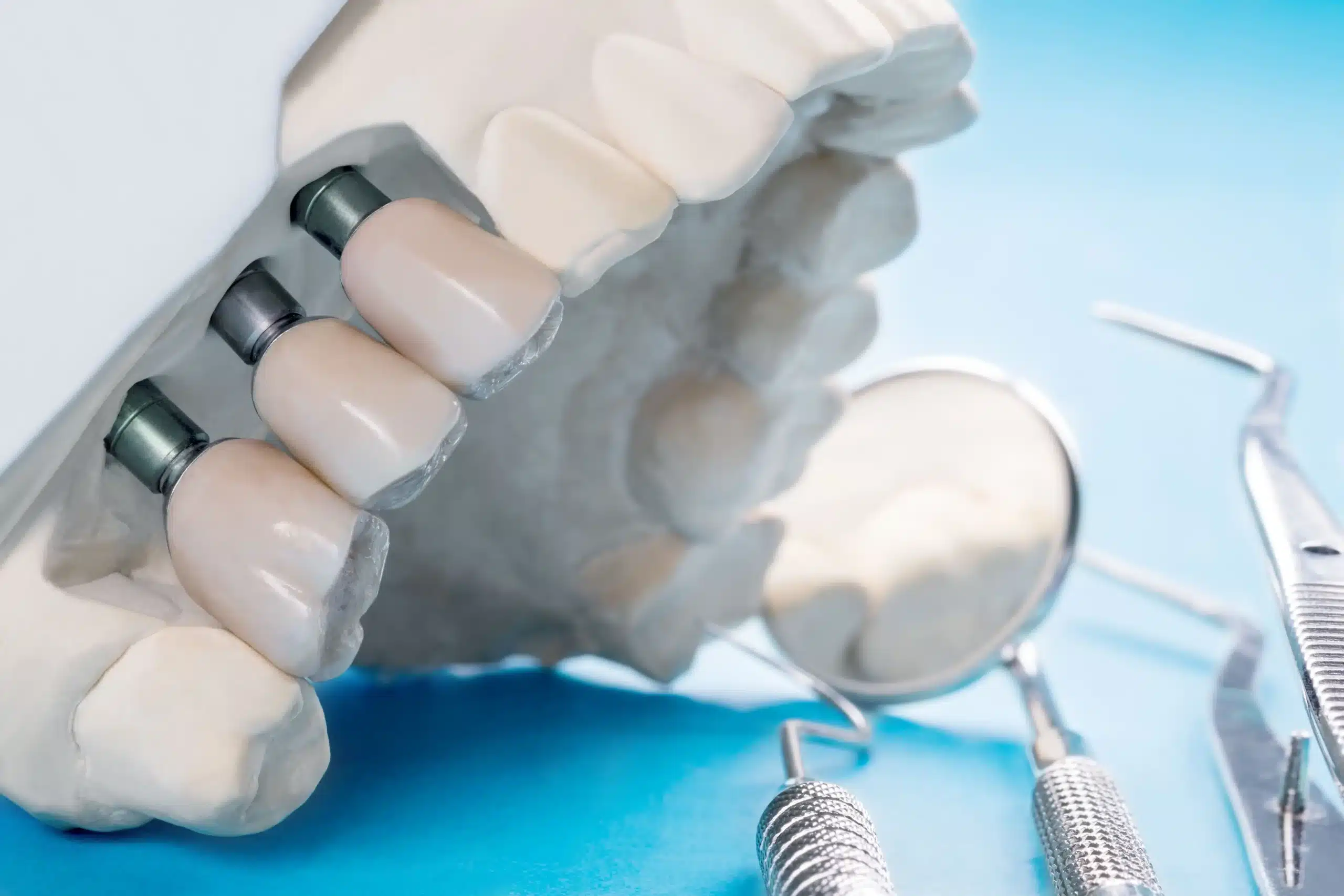 Riesgos Implantes Dentales en Madrid las tablas clinica dental quintero