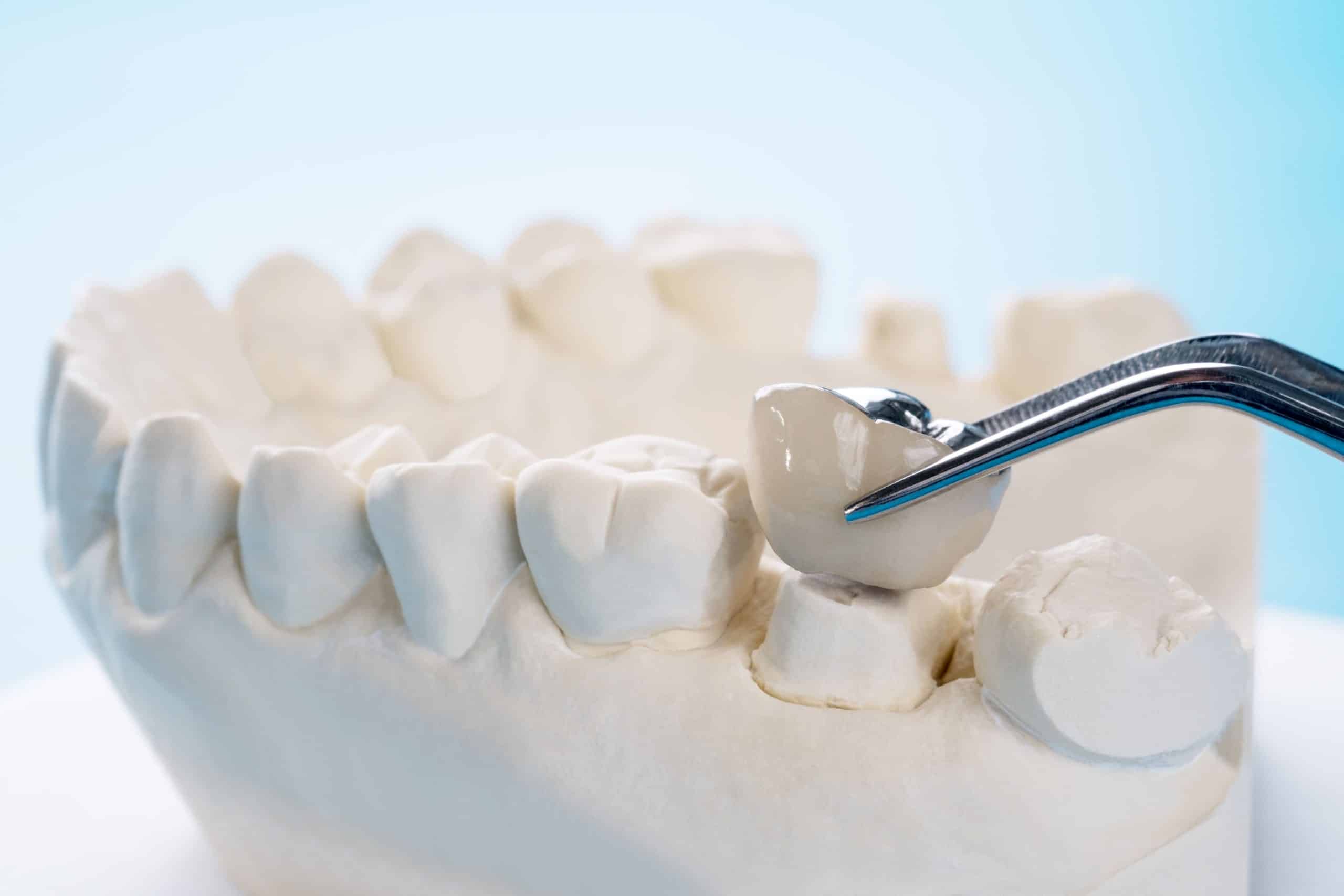 Las Mejores Opciones De Coronas Dentales Para Implantes En Madrid Las Tablas quintero dental