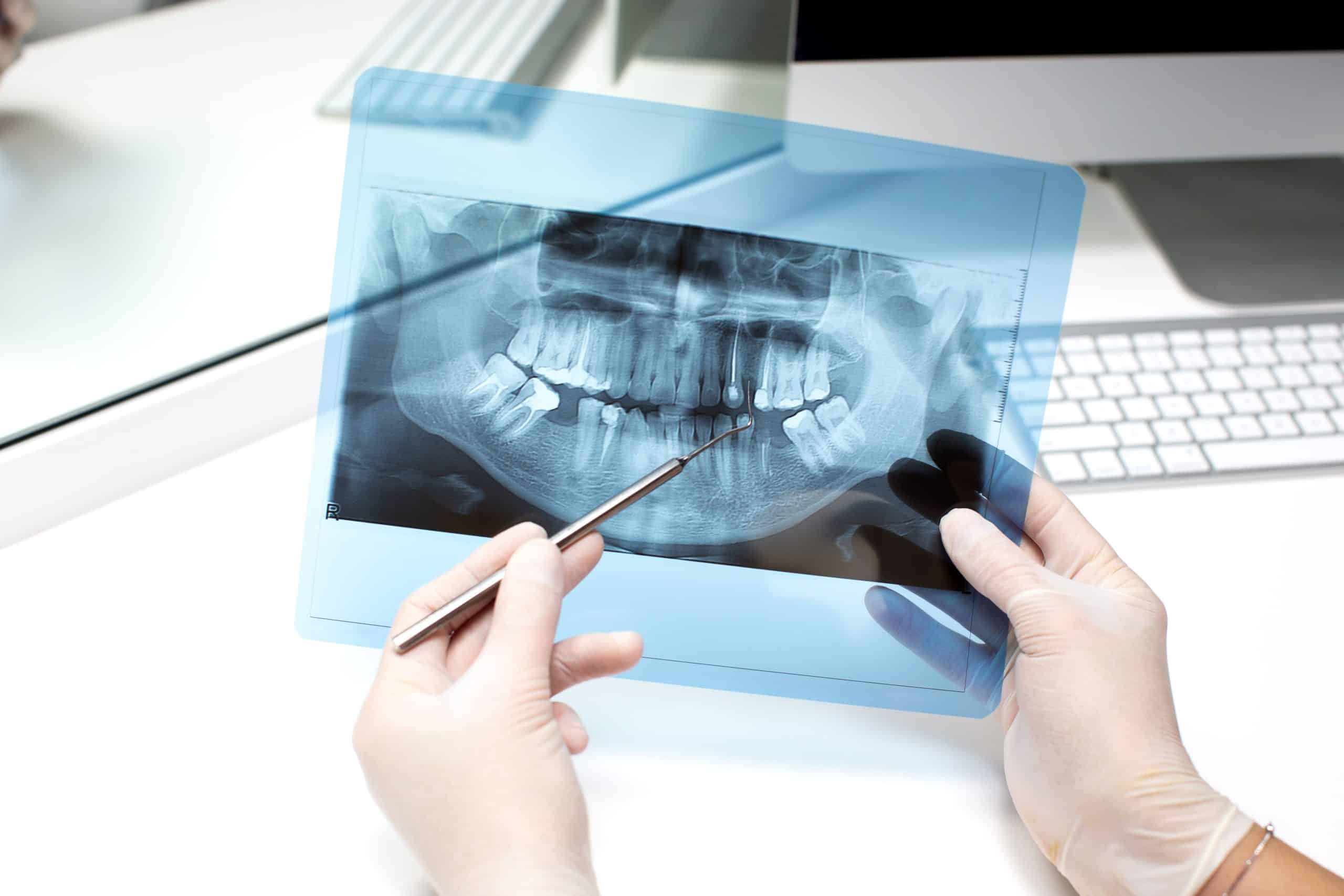 Puentes-Dentales-Y-Su-Relacion-Con-Los-Implantes-Dentales-En-Madrid-Las-Tablas-quintero-dental