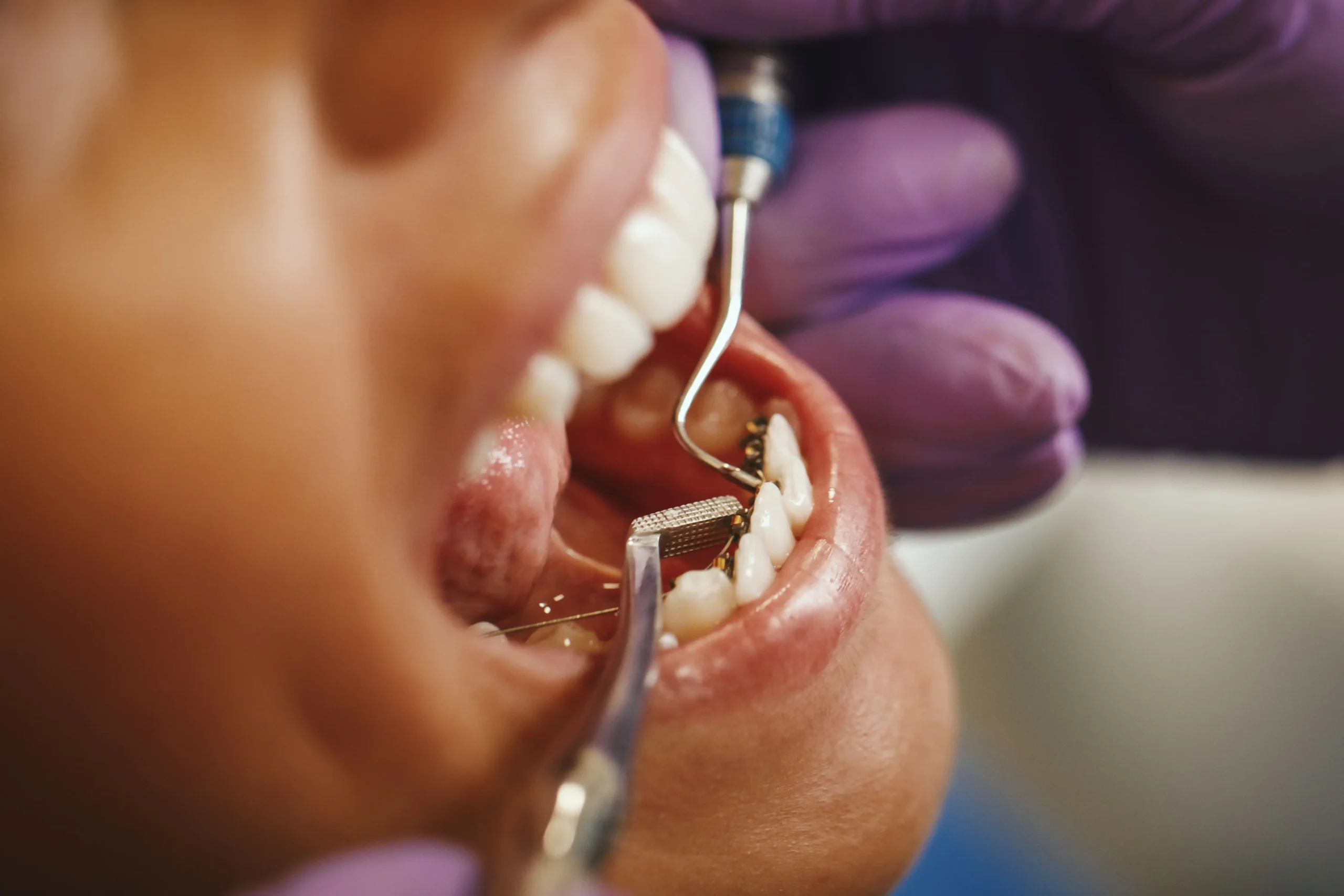 Impacto Del Apiñamiento Dental En Madrid Las Tablas quintero dental