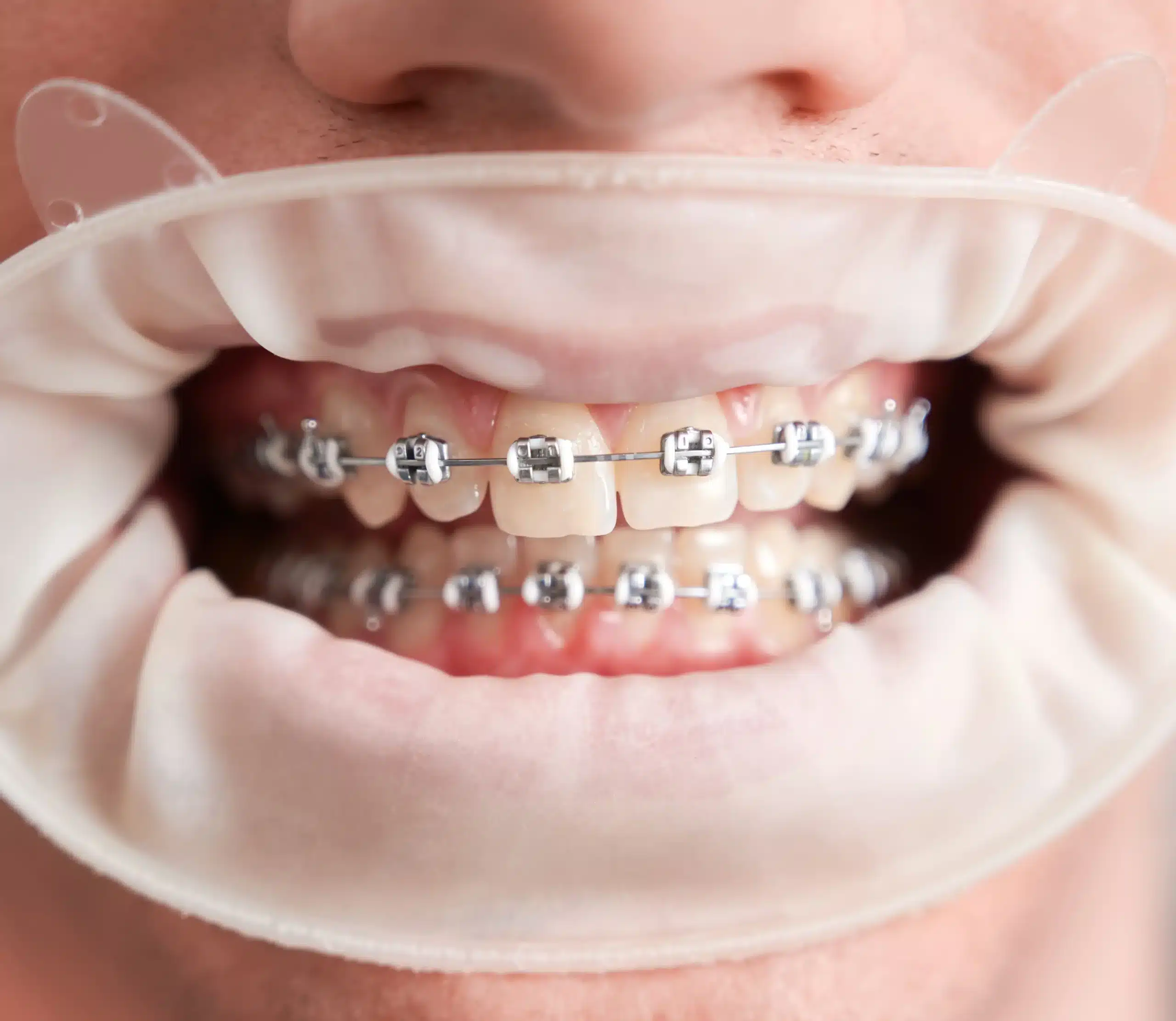 Diferencia Entre Odontología Y Ortodoncia En Madrid Las Tablas quintero dental