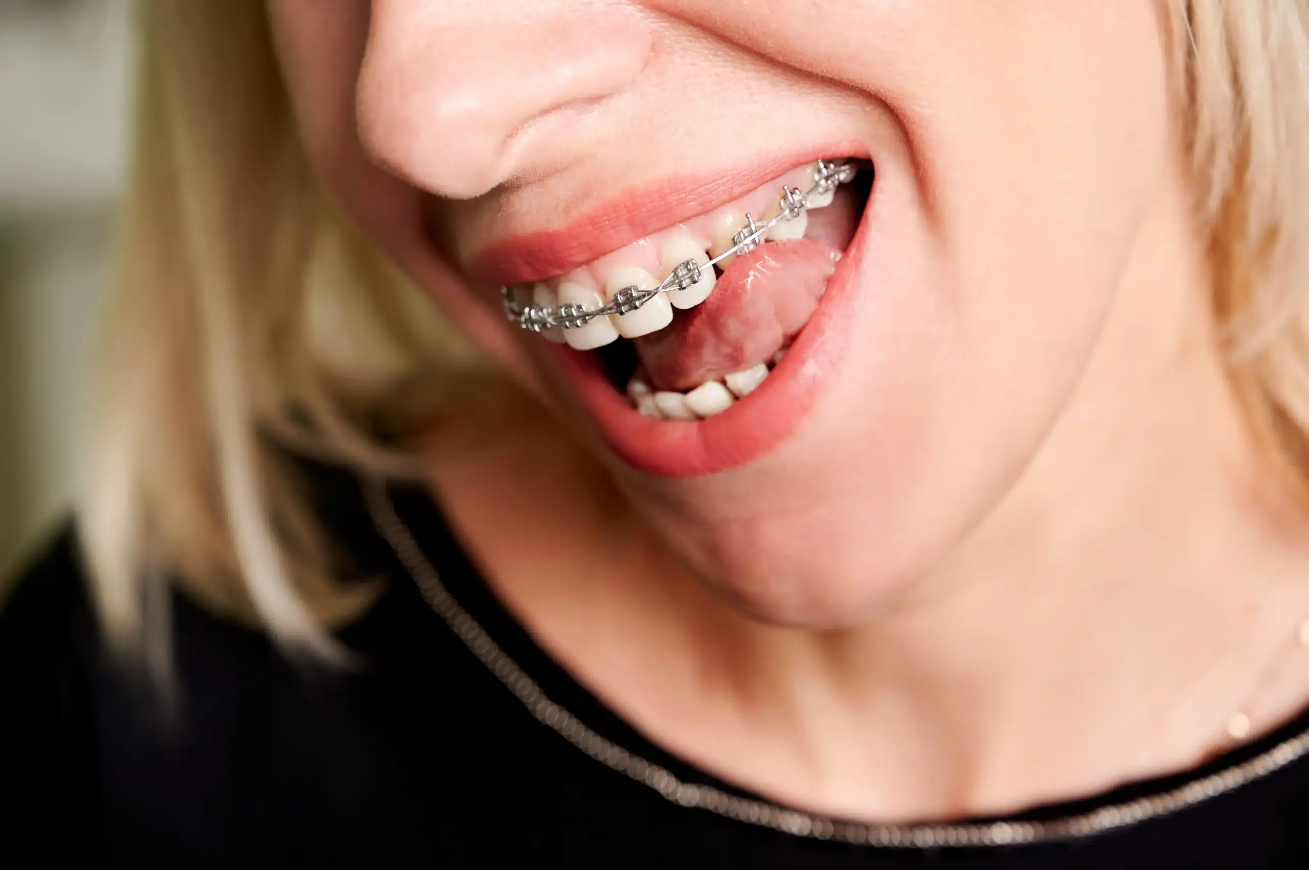 Encuentra El Mejor Ortodoncista En Madrid las tablas quintero dental